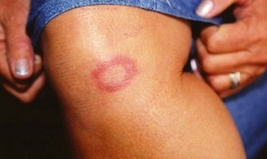 Hanseníase: marcas do preconceito é tema do Caminhos da Reportagem